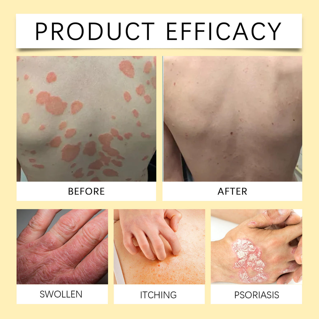 OCEAURA Herbal Psoriasis Care Soap, Soothing And Moisturizing Skin Refreshing Soap